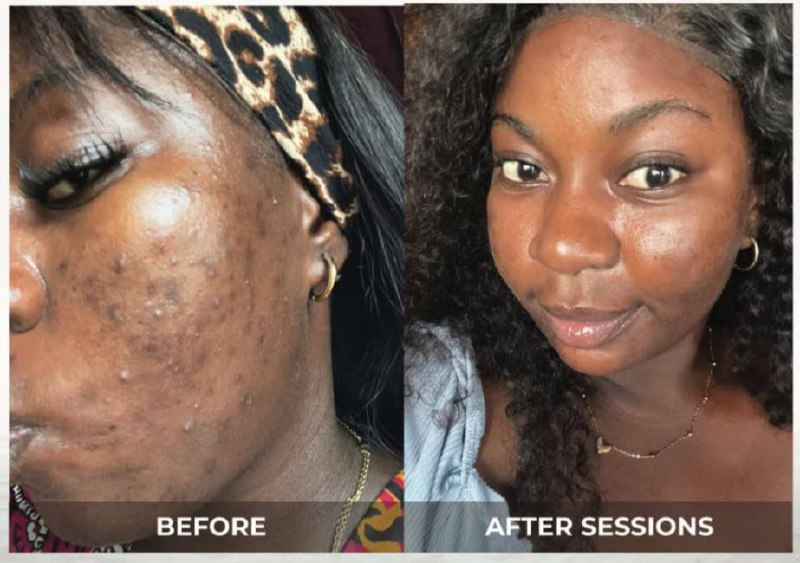 Clear Skin Journey — before and after at Gilcess Medical & Aesthetics