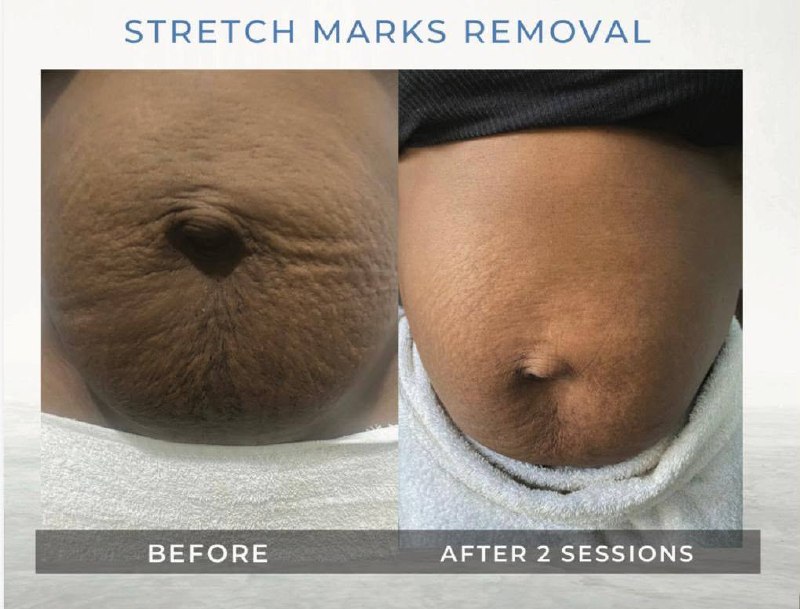 Body — Stretch Mark Removal — before and after at Gilcess Medical & Aesthetics