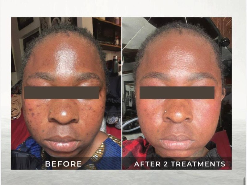 Acne Removal & Rejuvenation — before and after at Gilcess Medical & Aesthetics