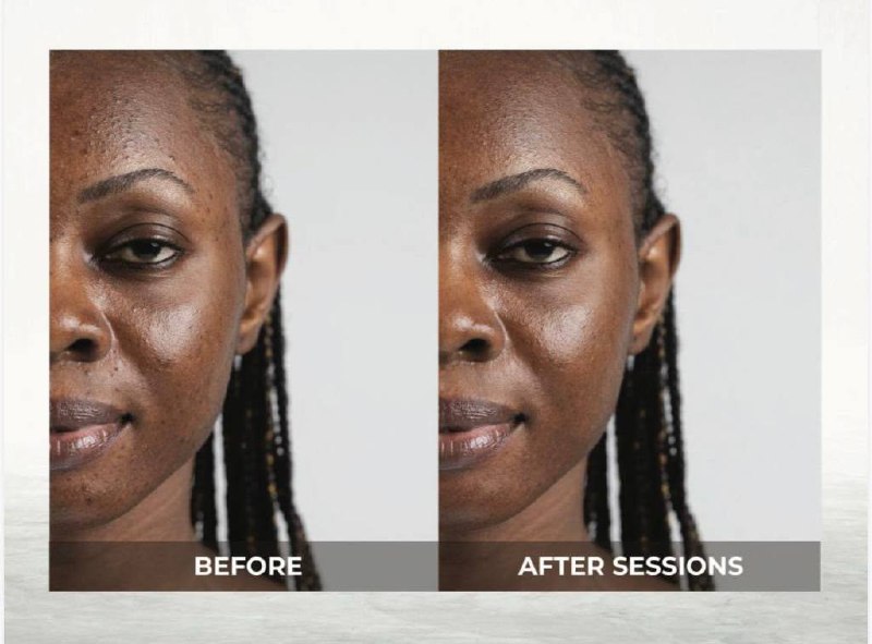 Peel Treatment — before and after at Gilcess Medical & Aesthetics